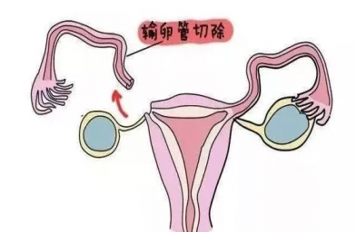 辽宁慈铭博鳌国际医院三代试管婴儿，切除双侧输卵管还能做试管婴儿吗？